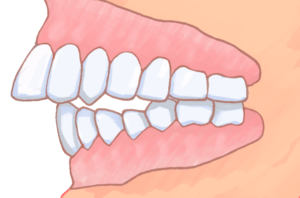 【トラブル】歯科矯正したはずが“出っ歯”に　“治療費トラブル”150人超被害
